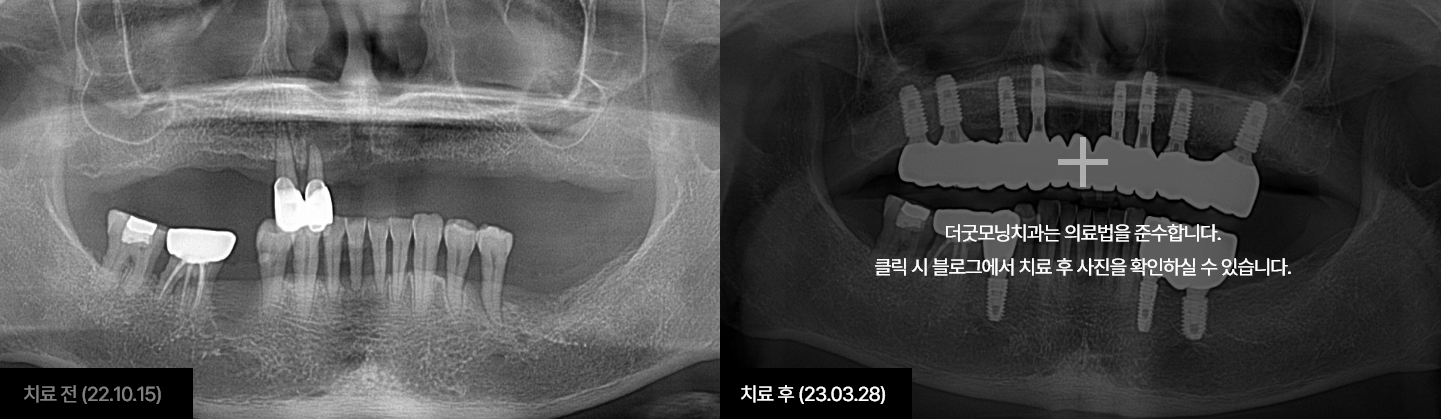 임플란트 케이스 4