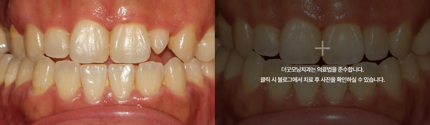 라미네이트 케이스 2