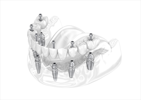 전체임플란트 설명