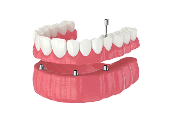 임플란트 틀니 설명