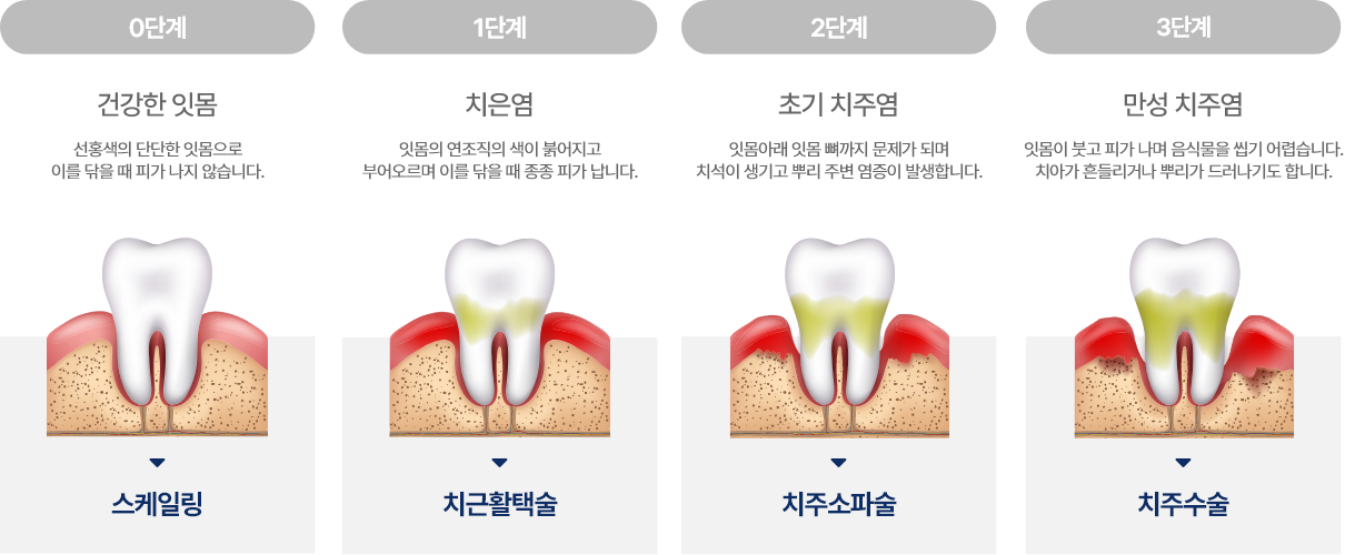 치주염 단계별 설명