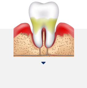 치주소파술 아이콘