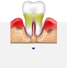 치주수술 아이콘