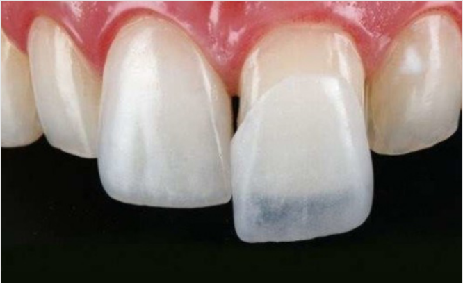 실제 앞니 라미네이트 접합